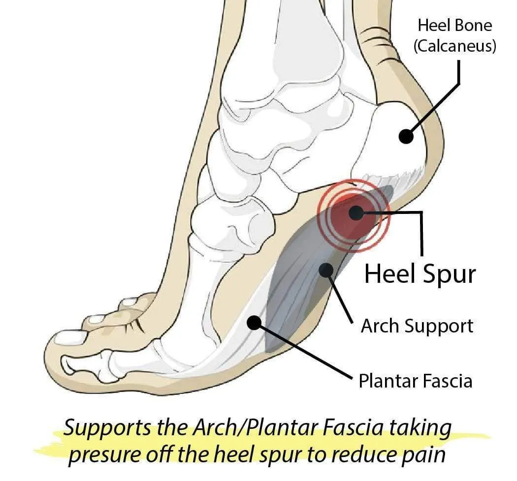 FootMatters Arch Support Cushions - Prevent Foot Pain